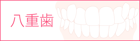 八重歯の矯正治療の抜歯について