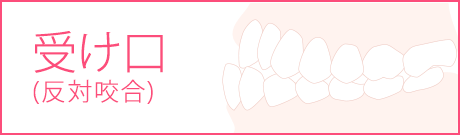 受け口の矯正治療の抜歯について