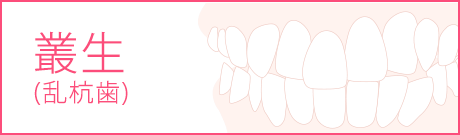 叢生の矯正治療の抜歯について